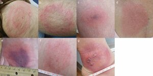 Examples-of-primary-erythema-migrans-patterns-a-EM-with-central-clearing-and-a-bullseye.jpg